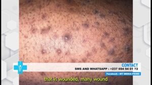 Filariasis and it manifestation