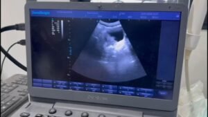 A rare encountered case of a bisexual baby pt1